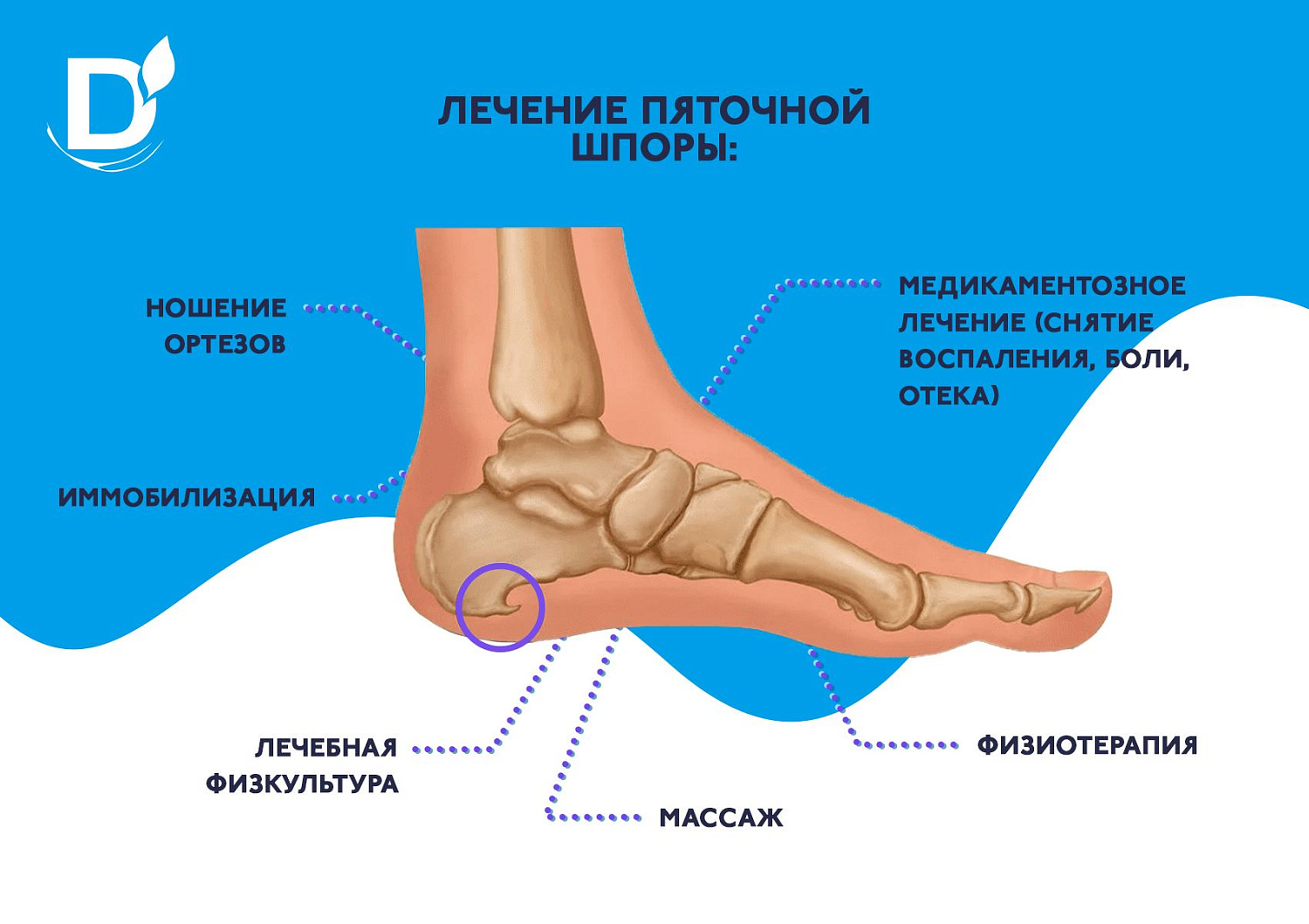 Что нужно знать про пяточные шпоры?